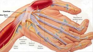 Đau dây thần kinh tay phải là biểu hiện của bệnh gì?