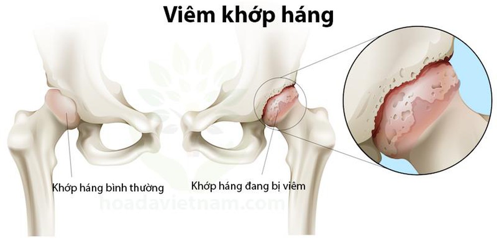 Bệnh viêm khớp háng có nguy hiểm không? 4 cách phòng hiệu quả