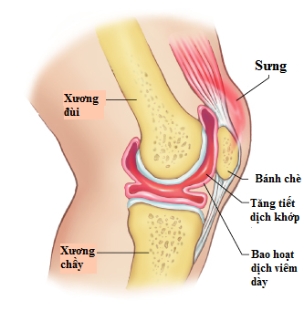 Mỏi khớp gối – coi chừng các bệnh lý nguy hiểm