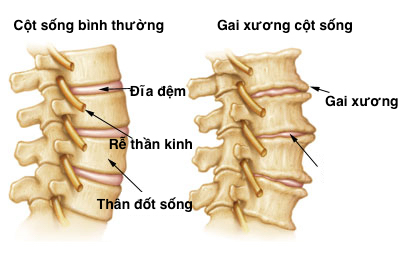 4 nguyên nhân gai cột sống, SỐ 1 phổ biến nhất