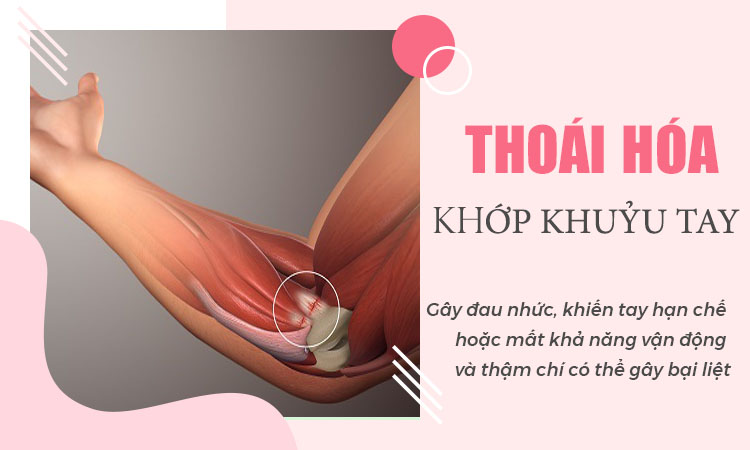 Tổng quan tất cả về bệnh thoái hóa khớp khuỷu tay