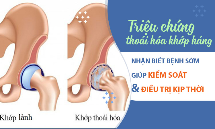 Triệu chứng thoái hóa khớp háng - Đừng chủ quan với những cơn đau