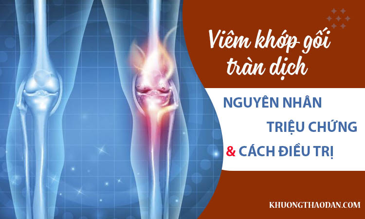 Những điều bạn cần biết về viêm khớp gối tràn dịch