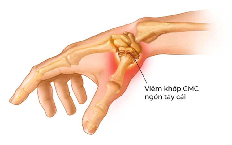 Đau khớp tay, đau khớp khuỷu tay uống thuốc gì?