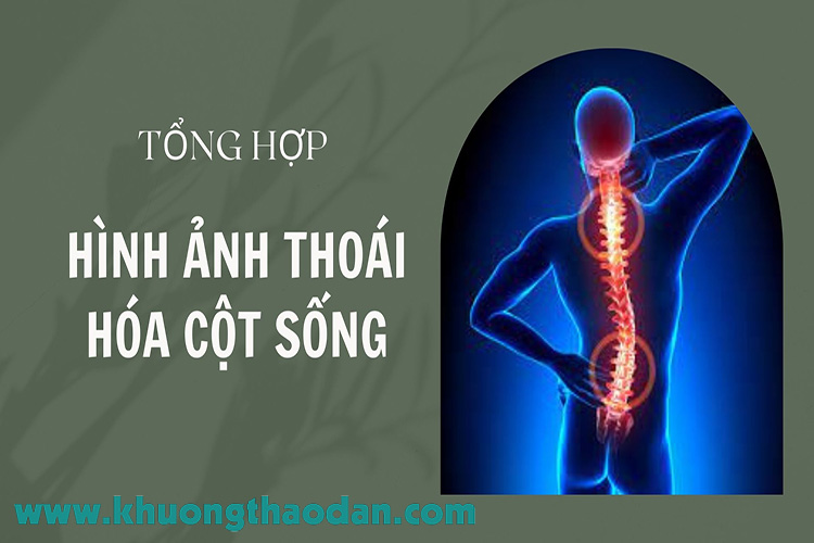 Tổng hợp hình ảnh thoái hóa cột sống theo từng vị trí